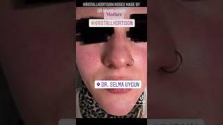 Kristallkortison Behandlung von Nasen made by Dr. med. Selma Uygun