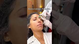 PRP Therapy for Face
