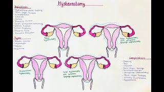 Hysterectomy - Indications, Types, Procedure, Complications