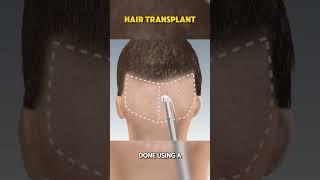 #healing #facts #health #dentist #selfcare #doctor #therapy #therapyvideos #hairtransplant #hair
