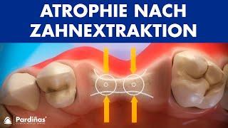 Atrophie nach Zahnextraktion ©