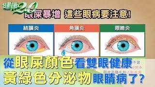 從眼屎顏色看雙眼健康 黃綠色分泌物眼睛病了？ 健康2.0