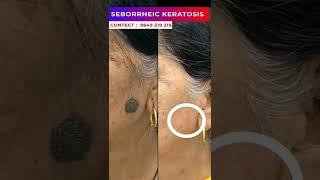 Seborrheic Keratosis treatment at Skinaa clinic #viralshorts  #serborrheic_keratosis #skinaaclinic