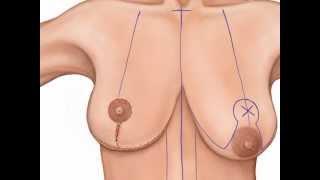 Anchor-Style Mastopexy Animation