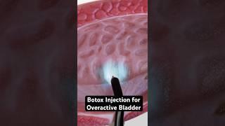 Botox for bladder control (3D Animation)