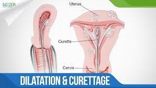 Proses Kuret yang perlu Anda ketahui - Dilatation and Curettage/ Go Dok Indonesia