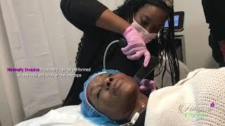 Morpheus RF Microneedling in Atlanta