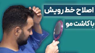 اصلاح خط رویش با کاشت مو:دستیابی به خط رویش مورد علاقه با انجام کاشت مو