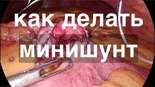 Елагин: как делать мини гастрошунт // шунтирование желудка с одним анастомозом