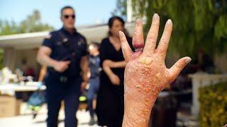 A ring gets stuck on a woman's finger due to an allergic reaction