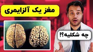 چند حقیقت درباره بیماری مخوف آلزایمر که نمیدونستید | چجوری از آلزایمر جلوگیری کنیم؟!