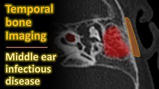 Temporal Bone Imaging - Middle ear infection