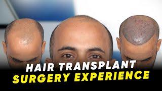 Hair Transplant in Burhanpur | Best Results & Cost of Hair Transplant in Burhanpur