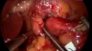 Acid Reflux Surgery