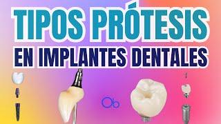 Tipos de Prótesis en Implantes Dentales