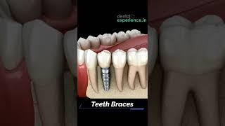 Implant | Dental Implants | Tooth Implant (For Tooth Replacement).