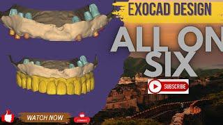 EXOCAD TUTORIAL :  HOW TO DESIGN ALL ON SIX IMPLANT WITH ACCESS HOLE