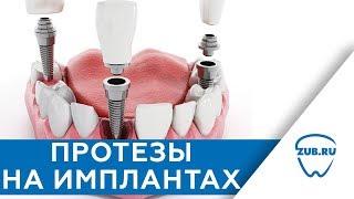 Двухэтапная имплантация. Одномоментная имплантация