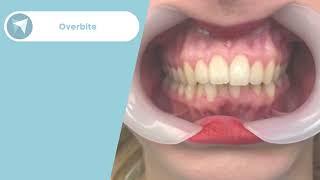 Overbite Treatment Before / After - Forest & Ray - Dentists, Orthodontists, Implant Surgeons