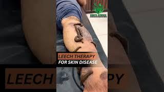 leech tharapy in skin disease aczema, psoriasis,acne, malasma, #drdeepikapatidar #leechtherapy