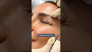 #oberlidstraffung #oderlid #lidstraffung #düsseldorf #plastischechirurgie #blepharoplastysurgery