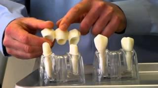 Dental Bridges vs Dental Implants