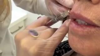 Smooth Stubborn Lip Lines- Juvederm Volbella with. Dr. Julie Russak