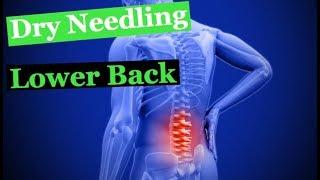 Lower Back Chiropractic Adjustment and Dry Needling