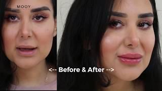 MOOY Clinics - 4D Lip Injector Set - Tutorial (Short version)