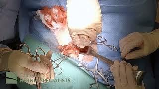 Open Inguinal Hernia Repair at California Hernia Specialists (4K)