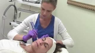 Micro-Needling Procedure Demo