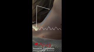 Normal Jugular Venous Pulse (Narrated)