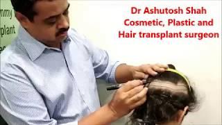 Female Hair Transplant Surgery with FUT Hair Transplant Technique, Surat, Gujarat, India.