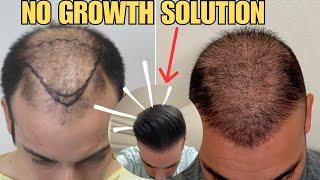 Hair Transplant No Growth- SOLUTION