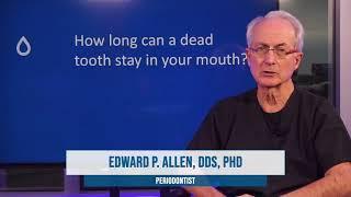 How long can a dead tooth stay in your mouth? - Video #150 - Periosciences