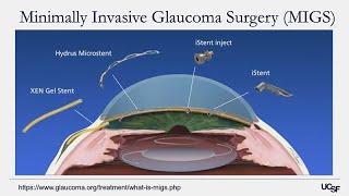 Understanding Glaucoma Diagnosis, Treatment, and Research on the Horizon