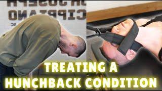 Guy Gets Extreme Treatment For Hunchback