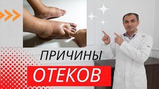 Отличие венозных отеков от других видов отеков. Флеболог Москва.