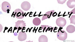 Pappenheimer Bodies & Howell-Jolly Bodies: Peripheral Blood Smear (Hematology & Hematopathology)
