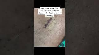 Keloid Scar Removal #shorts