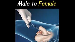 How To Change Male Gender To Female...(Gender Reassignment Surgery) (2020)