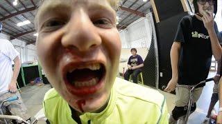 EPIC FACEPLANT !!! BROKEN TEETH !!!