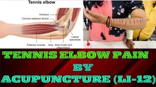 TENNIS ELBOW PAIN BY ACUPUNCTURE (LI-12)