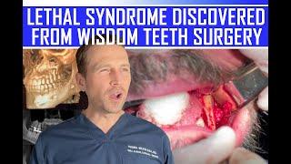 LETHAL SYNDROME DISCOVERED from WISDOM TEETH