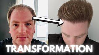 Mike's FUE Hair Transplant Journey *Defeat The Norwood Reaper