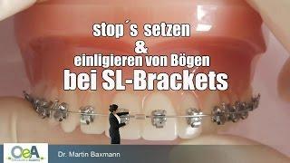 OeA I Bogenwechsel bei SELBSTLIGIERENDEN BRACKETS / Archwire change in selfligating brackets