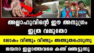 ജന്മനാ വിരലടയാളം ഇല്ലാത്ത ഇവരുടെ ഈ അവസ്ഥ കണ്ട് ലോകം ഞെട്ടുന്നു/Bukhara Media