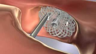Spine Surgery Animation - Neurologic & Orthopedic Hospital