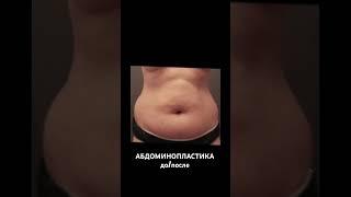 Абдоминопластика. Запись на консультацию ️ https://seoulguidemedical.com/ #абдоминопластика