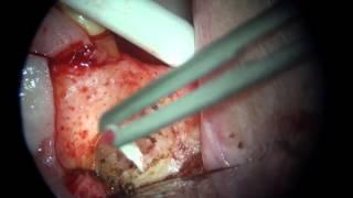 Micro-surgical Primary Endo